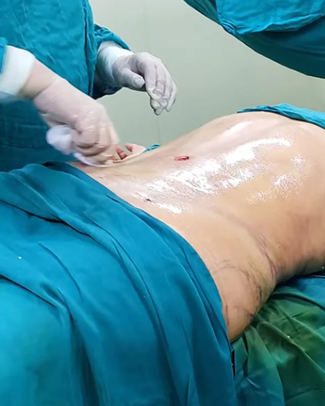 Registro visual de lipoescultura 2