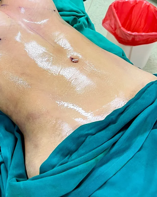 Registro visual de lipoescultura 3