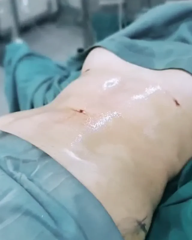 Registro visual de lipoescultura 6