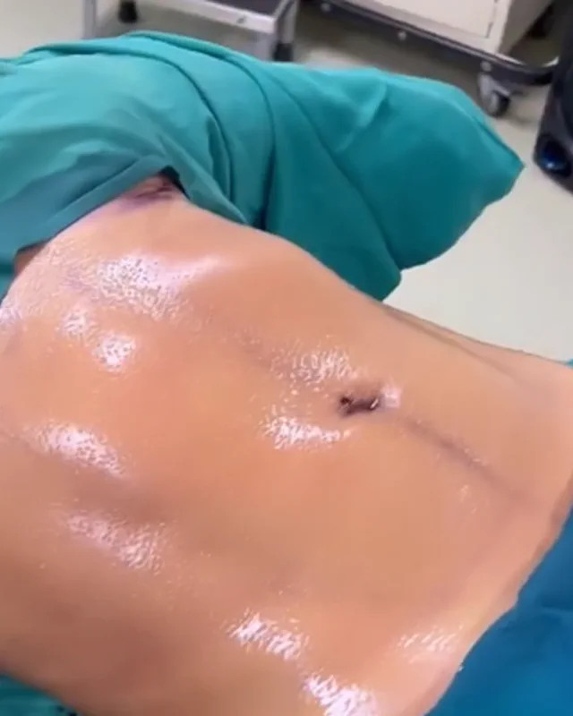 Registro visual de lipoescultura 7