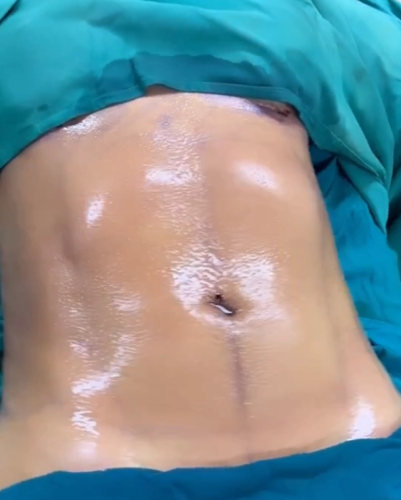 Resultado de Lipo Soft Definition 4
