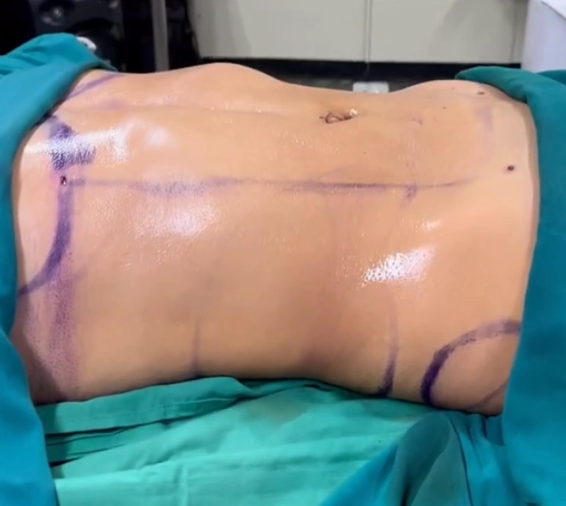 Resultado de Lipo Soft Definition 6