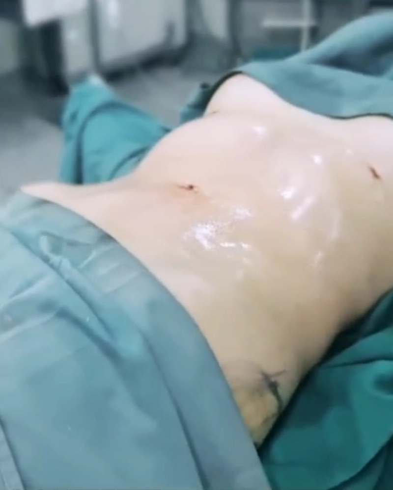 Resultado de Lipo Soft Definition 7