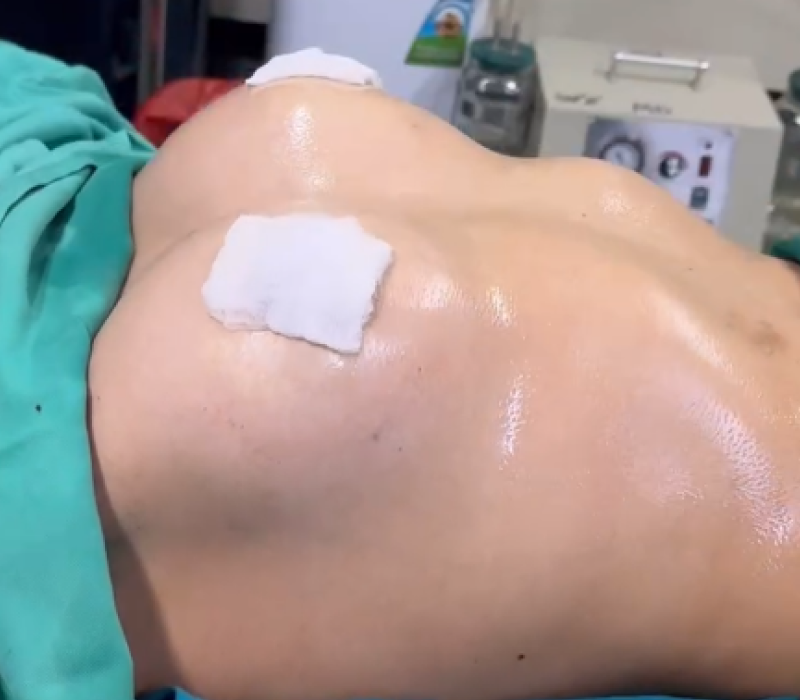 Resultado de Mamoplastia de aumento mamario con prótesis, caso 3