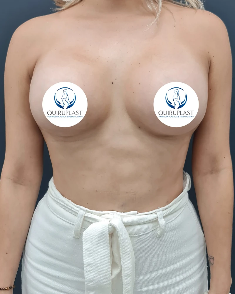 Resultado de Mamoplastia de aumento mamario con prótesis, caso 4