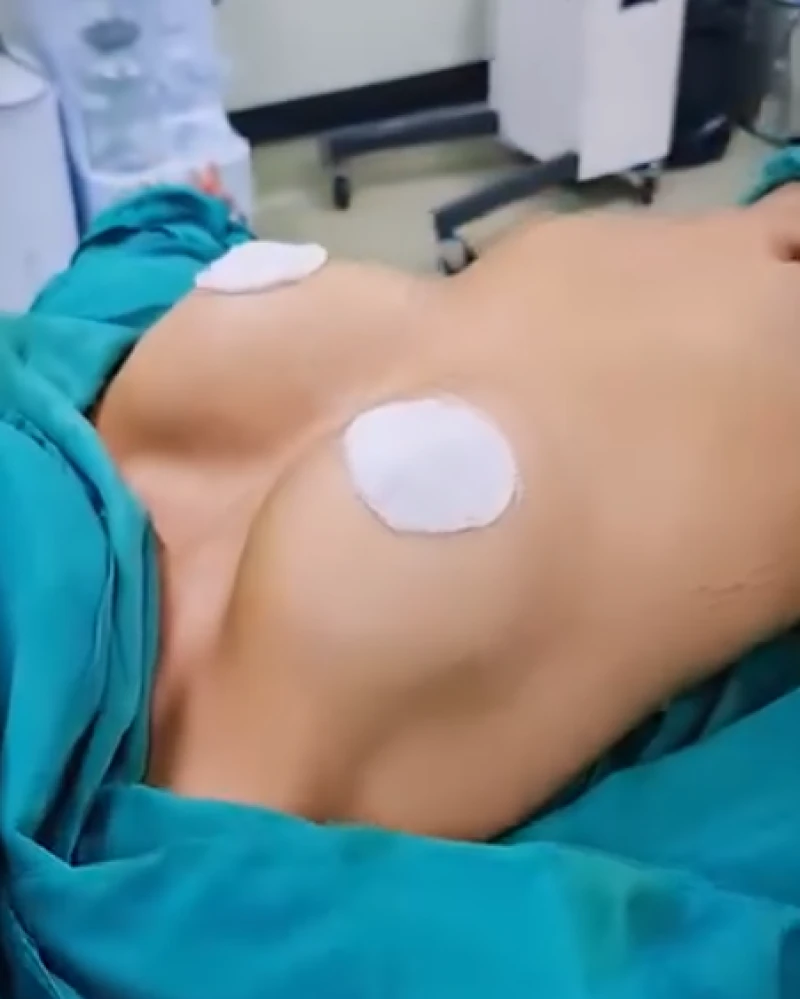 Resultado de Mamoplastia de aumento mamario con prótesis, caso 6